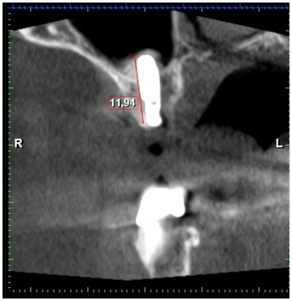 CBCT after internal sinus lift with implant placement.