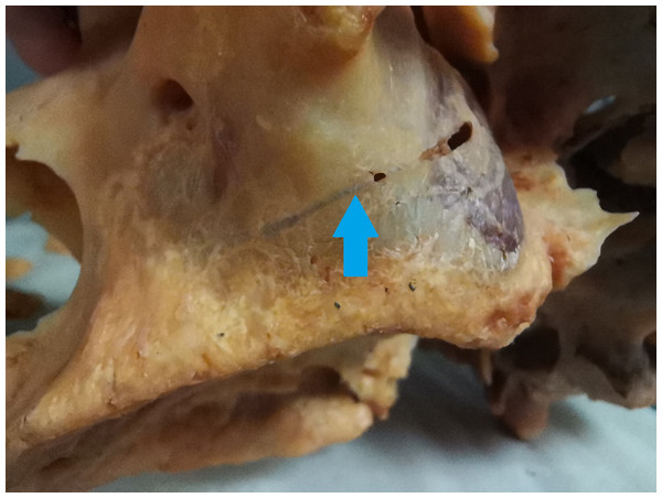 The bony canal of the alveolar antral artery on the skull.
