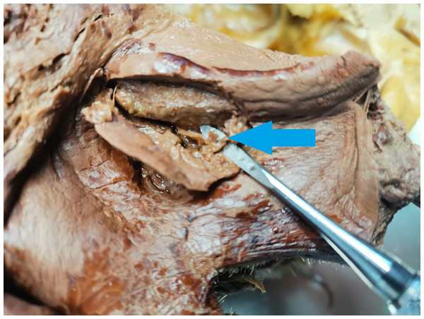 Alveolar antral artery during autopsy.