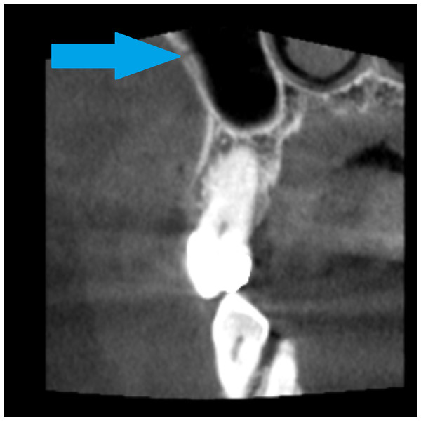 Bony canal of alveolar antral artery on the CBCT, coronal view, AAA is marked by a blue arrow.