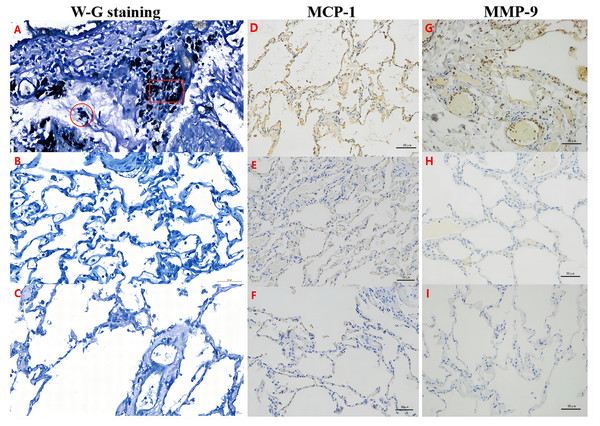 MCP-1 and MMP-9 expression was increased in the pulmonary tissues of the PSP patients by Wright-Giemsa (W–G) and immunohistochemical (IHC) staining.