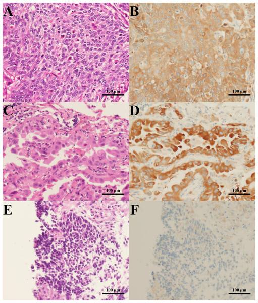 H&E staining and G6PD IHC staining of lung cancer tissues.