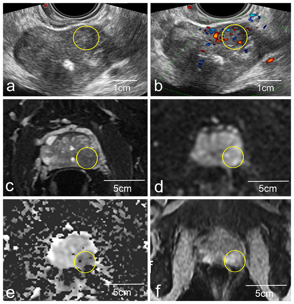 Representative images of a biopsy patient obtained via US (A and B) and mp-MRI (C–F).