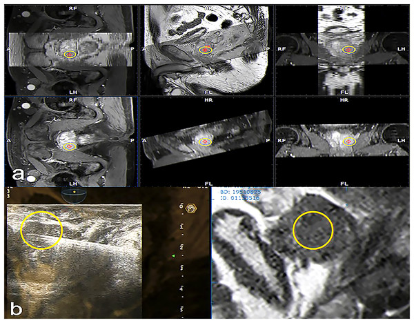 Fused MRI and trans-rectal US images for a patient with suspected PCa used to guide biopsy procedures.