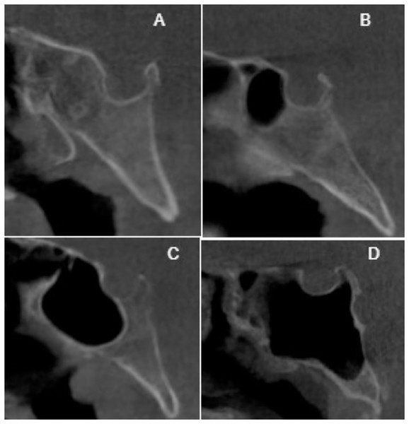 Cropped CT images in sagittal section conchal pneumatization (A), presellar pneumatization (B), incomplete sellar pneumatization (C), complete sellar pneumatization (D).