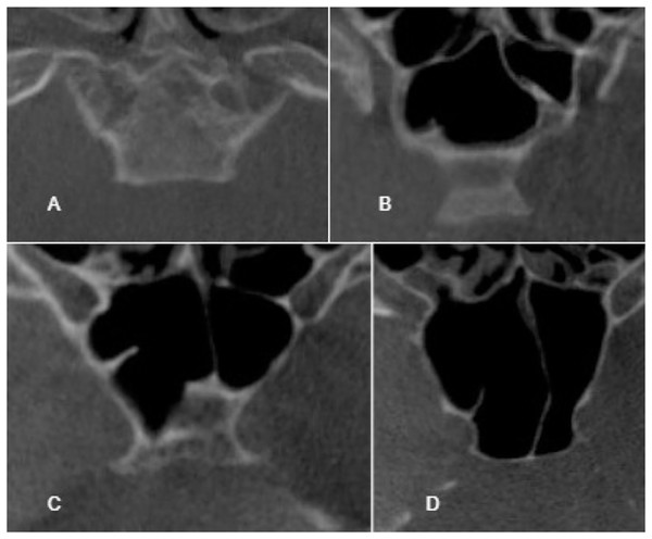 Cropped CT images in axial section conchal pneumatization (A), presellar pneumatization (B), incomplete sellar pneumatization (C), complete sellar pneumatization (D).
