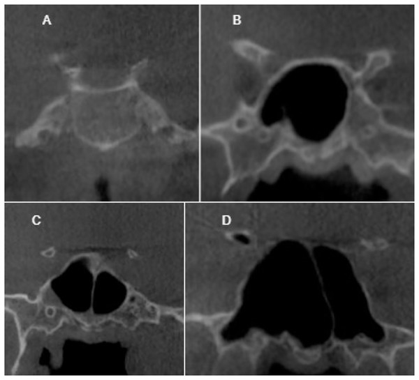 Cropped CT images in coronal section conchal pneumatization (A), presellar pneumatization (B), incomplete sellar pneumatization (C), complete sellar pneumatization (D).