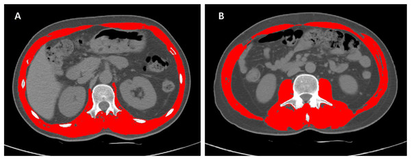 Examples of L1 and L3 delineation using Slice-Omatic software.