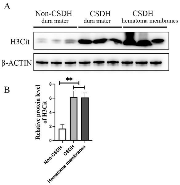 H3Cit protein level increased dramatically in the dura mater and hematoma membranes of CSDH compared control.