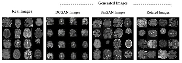 Real “no tumor” images compared with DCGAN, SinGAN, and geometric-based generated images.