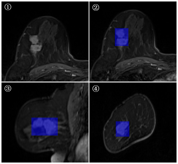 Minimum bounding cube segmentation method based on the post-contrast T1WI series.