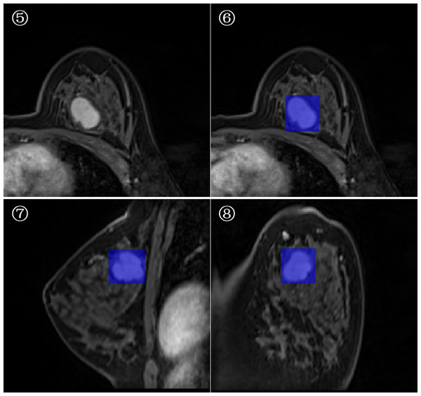 Minimum bounding cube segmentation method based on the post-contrast T1WI series.