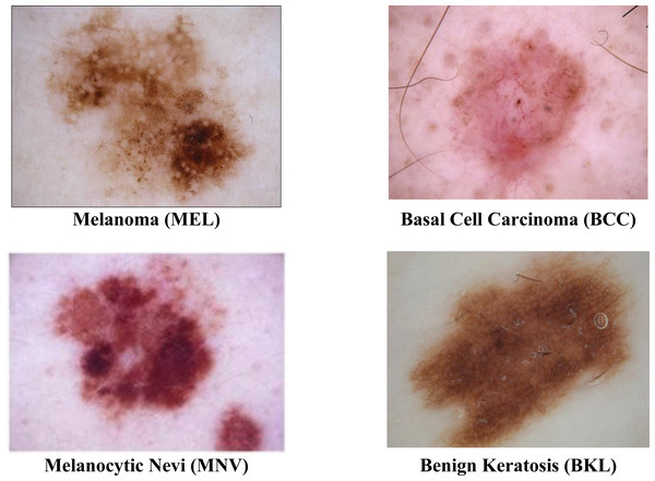 Sample images of multiple skin cancer classification.