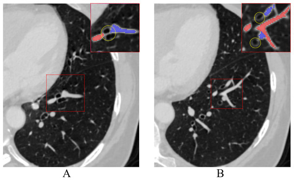 The process of pulmonary vessels moving away from the hilum accompanied by the bronchi on CT.
