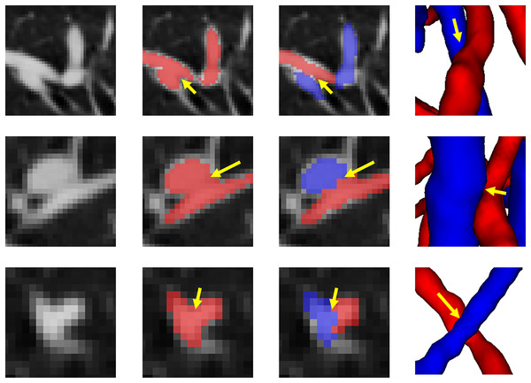 The results of separation of arterial and venous intersections are shown in this figure.