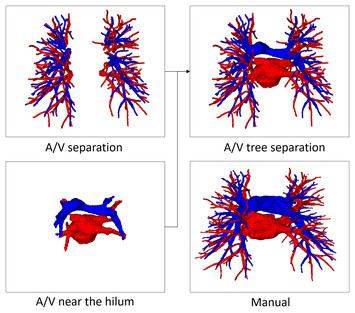 Automatic pulmonary artery-vein separation in CT images using a