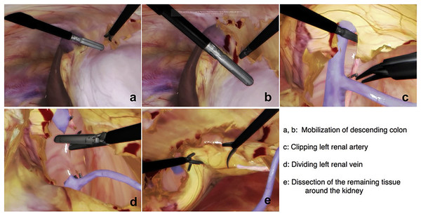 Steps to identify the structure and perform laparoscopic nephrectomy using LAPVision.