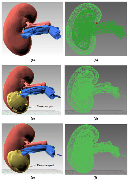 Step-wise 3D modeling of kidney organ and cancerous structure.