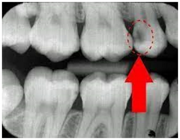 Radiograph explanation of tooth carries and normal.
