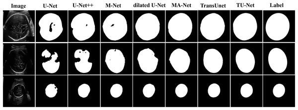 Segmentation results of different algorithms on fetal head datasets.