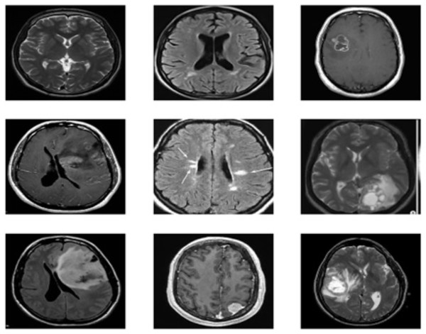 Sample images of brain tumor dataset.