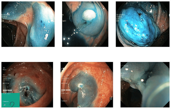Incorrectly detected images from the classes of dyed lifted polyps and dyed resection margins in the Kvasir V2 dataset (Pogorelov et al., 2018).