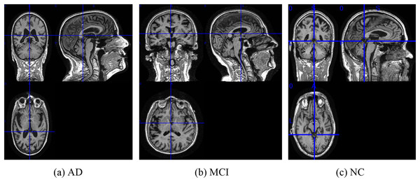 The examples of ADNI-I dataset.