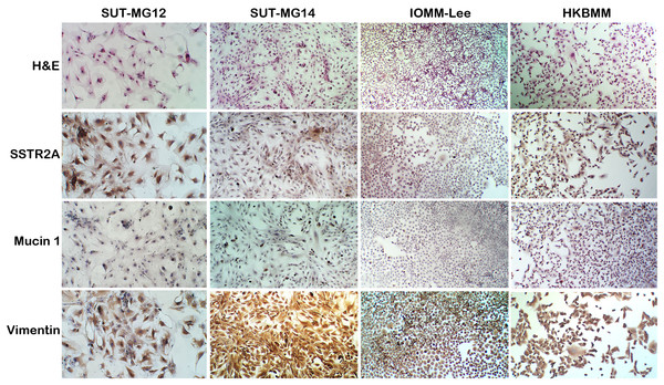 Characterization of primary benign meningioma cells.