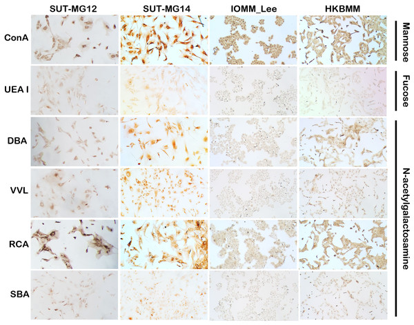 Lectin cytochemistry in primary benign and malignant meningiomas.