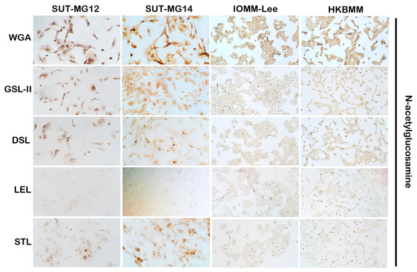 Lectin cytochemistry in primary benign and malignant meningiomas.