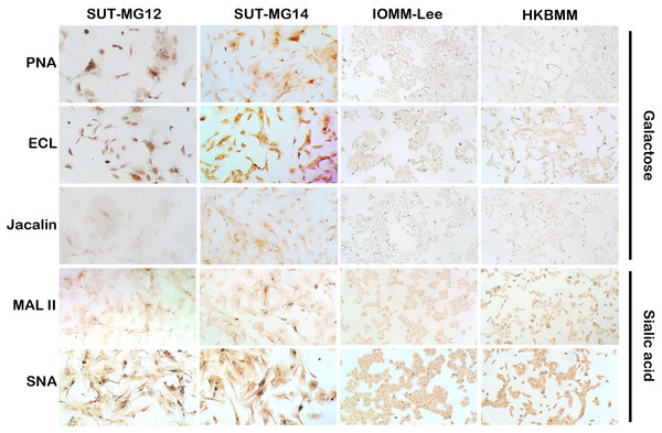 Lectin cytochemistry in primary benign and malignant meningiomas.