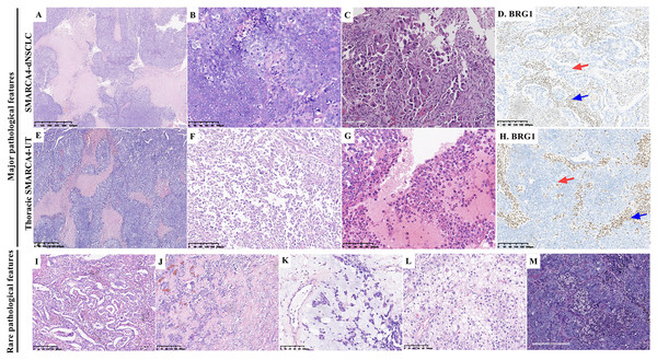 Pathological features of thoracic SMARCA4-deficient tumors.