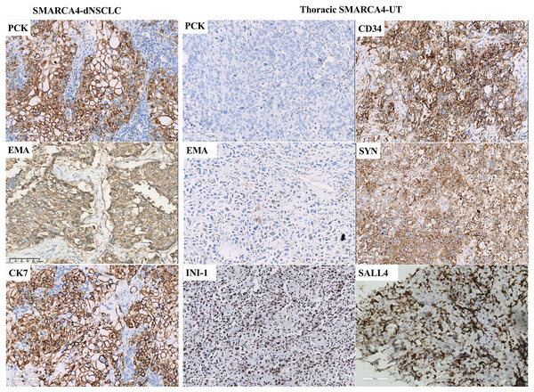 Immunohistochemical profile of thoracic SMARCA4-deficient tumors.