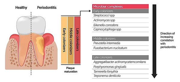 Bacterial residence of dental plaques (biofilm) and their association with periodontal diseases.