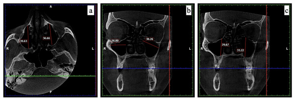The measurements recorded for maxillary sinus using CBCT.