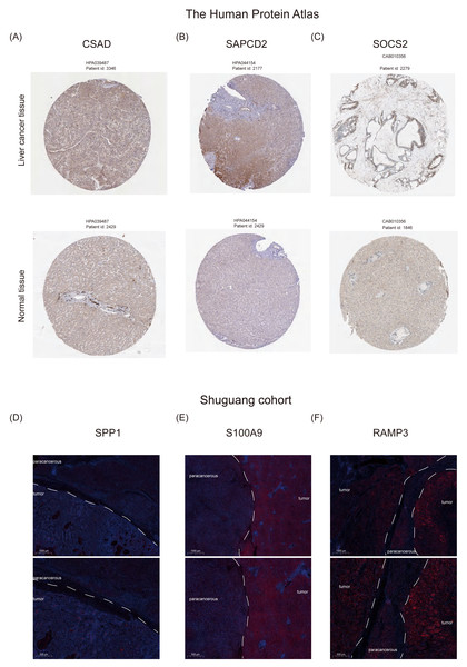 Protein expression levels of NHGRM signatures in the livers of patients with HCC.