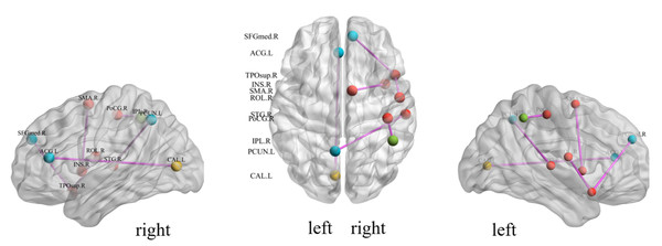 Diagrammatic representation of the relevant functional connections of important features in ASD.