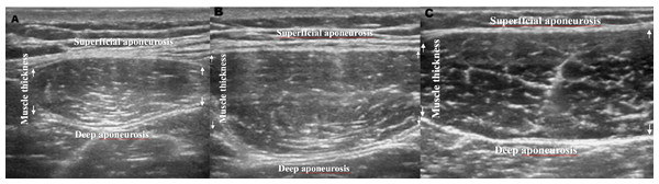 Images for quadriceps femoris.