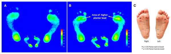 The color footprint image of the homogenized representative subject was presented by averaging the six subregional plantar loads of participants in the amateur group (n = 77) (A).