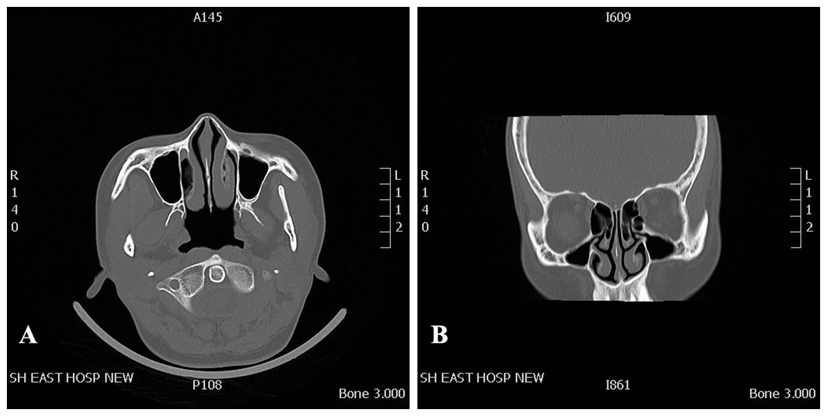 Comparative Study Of Nasal Cavity Drug Delivery Efficiency With 