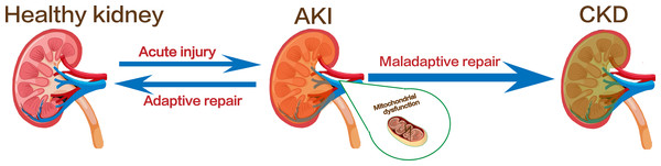 Kidney injury and the transformation of AKI to CKD.