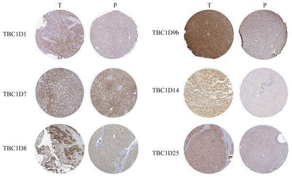 The protein expressions of TBC1Ds in HCC.