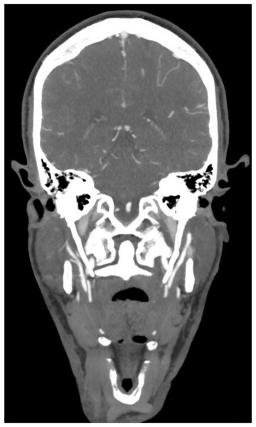 Neurological phenotypes and treatment outcomes in Eagle syndrome ...