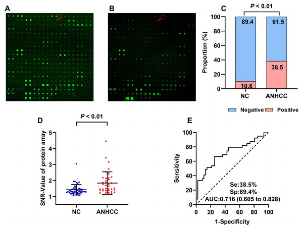 Anti-BIRC5 autoantibody was discovered by using protein microarrays.
