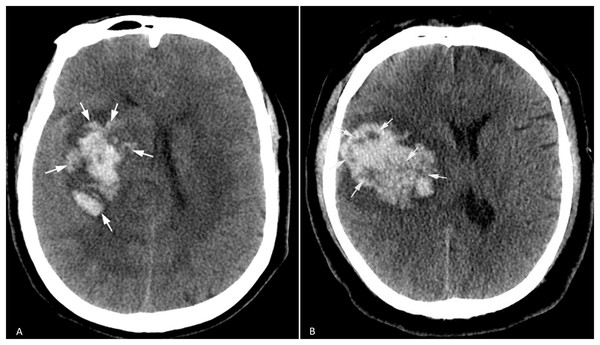 Irregular hematoma shape and heterogeneous hematoma density.