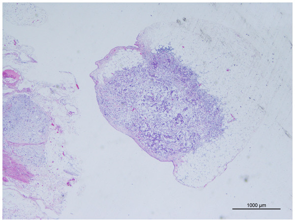 Tumor deposits (H&E, magnification ×20) cancer cells have been found in adipose tissue that is not connected to the primary lesion.