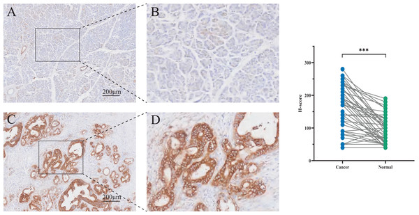 Immunohistochemistry (IHC) staining tissues of PCSK9 in pancreatic cancer.