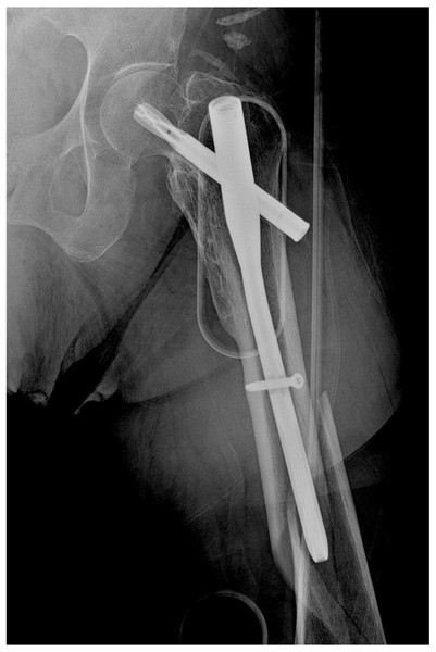 Case of peri-implant fracture below the implant.