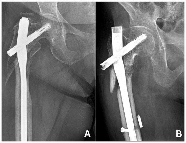 Cases of implant failure.