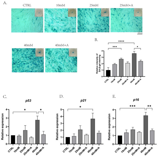 The effect of high glucose and ANXA2 on cellular senescence of PDLCs in medium with high glucose.